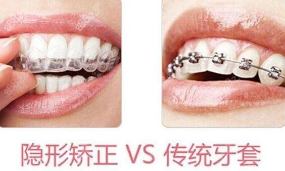 龙华区牙齿矫正的牙套是多少钱