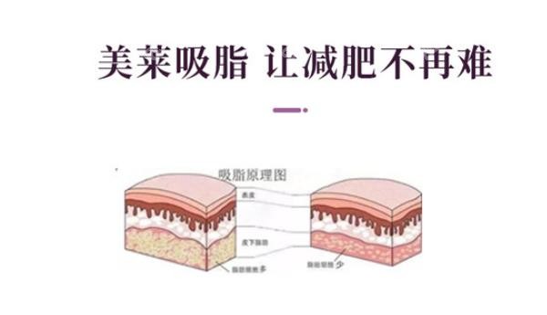 郑州美莱整形医院吸脂原理