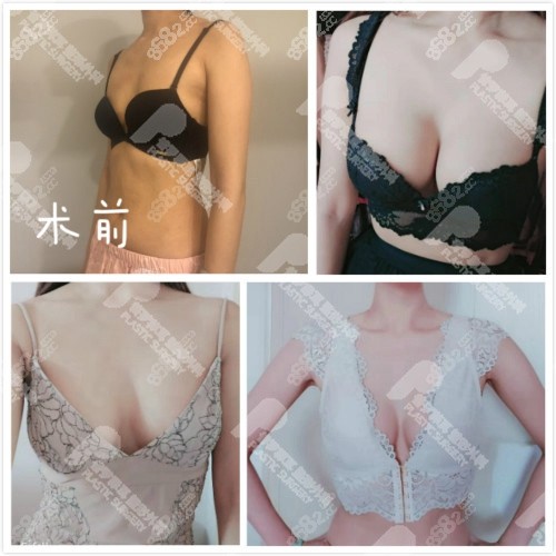 普羅菲耳鄭在皓做假體隆胸好不好