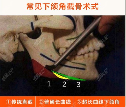 杭州连天美医疗下颌角整形