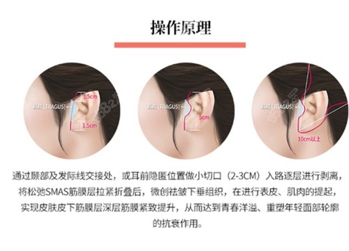 深圳曹孟君医疗美容拉皮技术优势