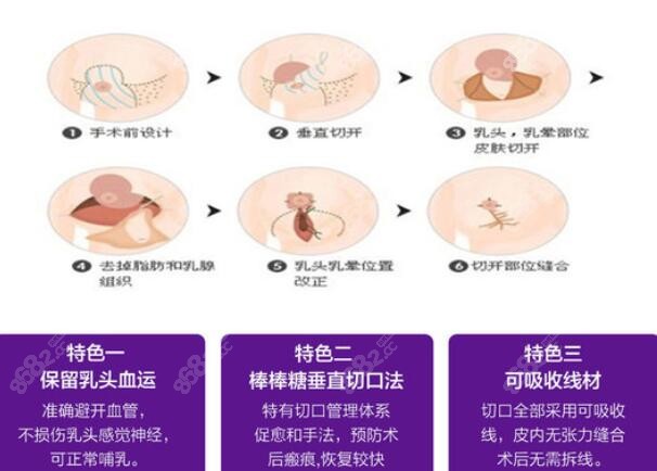 栗勇医生缩胸手术技术靠谱