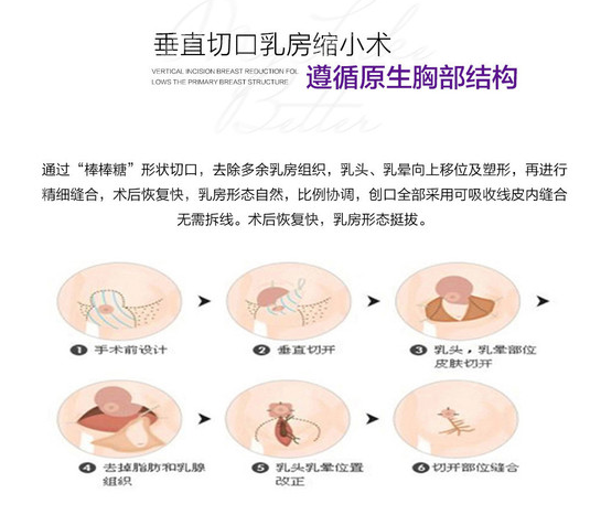 缩胸技术来看栗勇隆胸技术怎么样