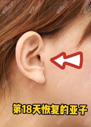 V美减龄面部提升手术切口