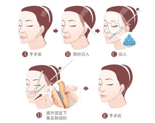 面部提升贵不贵