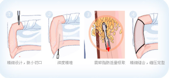 吸脂示意图