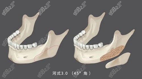 河东镐第三代下颌角手术