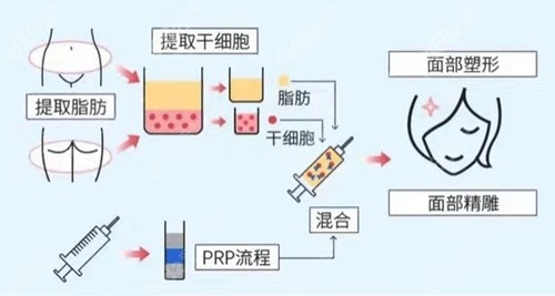 脂肪移植是不是越多越好