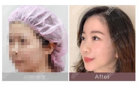<!--<i data=20240705-sp></i>-->速提美手术术后