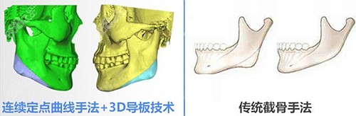 李雯做下颌角改脸型的优势