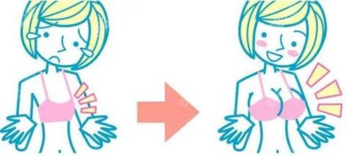 广州华美郝永生隆胸对比图