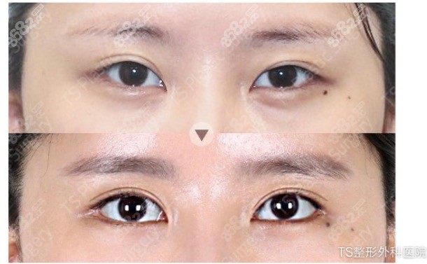韩国TS眼修复手术前后对比