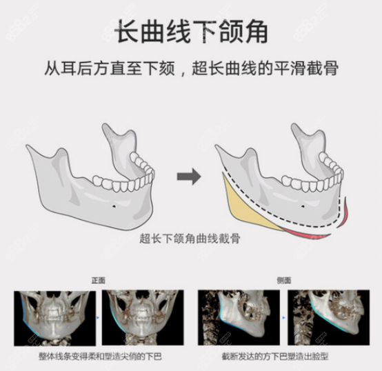 长曲线下颌角手术