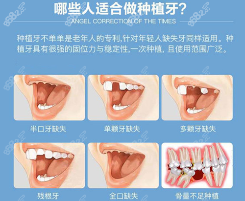 适合做种植牙的情况