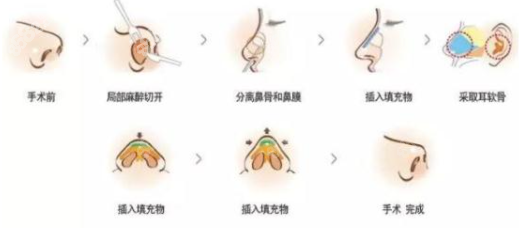 上海李鸿君做鼻子过程