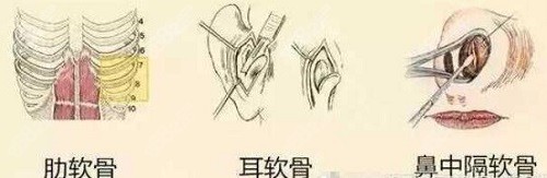 曹海峰医生隆鼻采用的软骨示意图