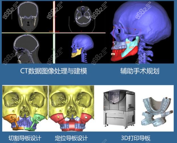 3D正颌手术优势