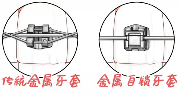 传统托槽与自锁托槽结扎丝的区别