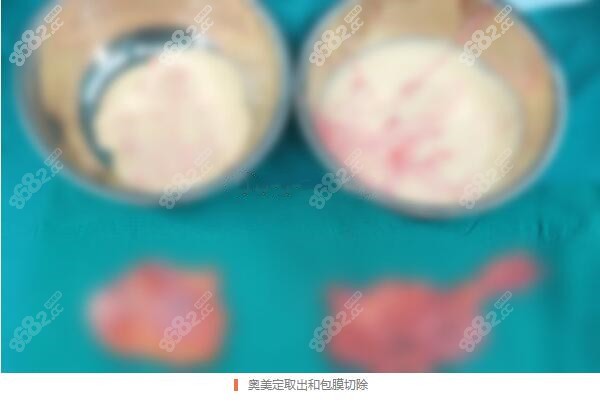 殷初阳医生做奥美定取出后的图片
