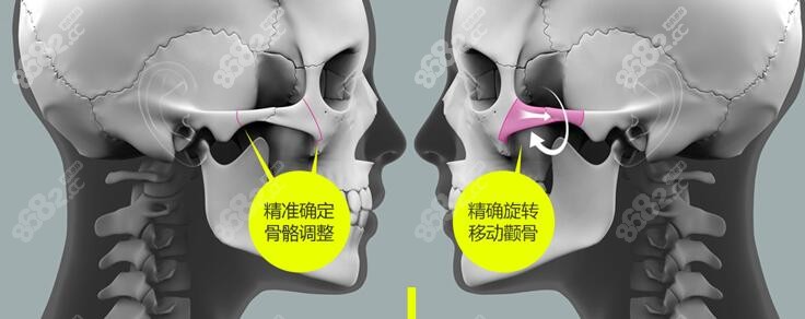 北京圣嘉新张笑天颧骨内推优势