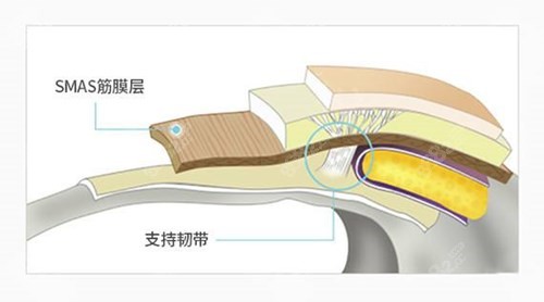 高亚东平面小切口拉皮原理