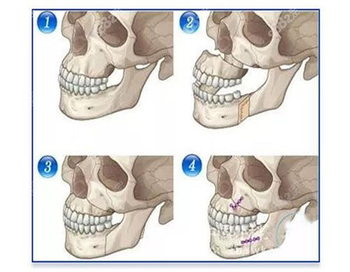 上海九院正颌手术、下颌骨手术多少钱