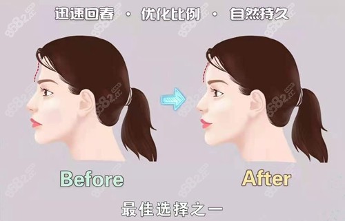 自體脂肪豐額頭前后對比