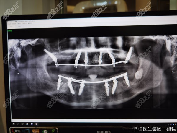 企业家朋友又来找黎医生做下半口种植