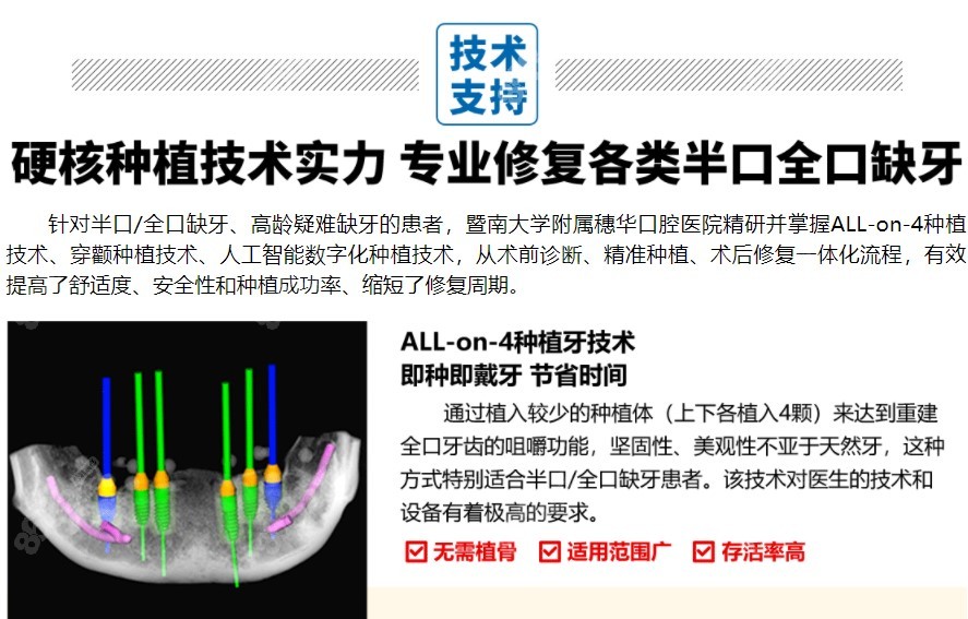 暨大穗华allon4半口全口种植牙技术