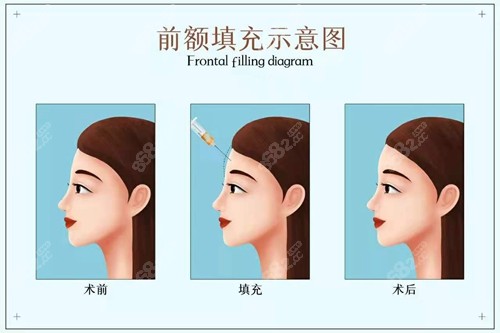 前額扁平怎么改善？
