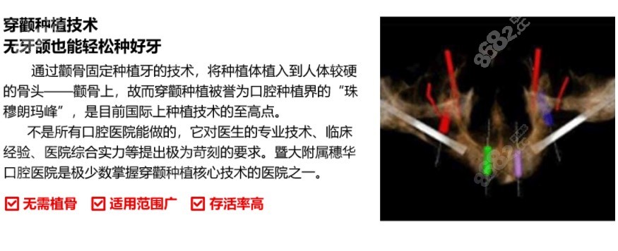 广州穗华口腔也可开展穿颧骨种植牙手术
