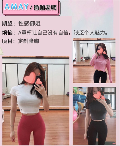 烟台洛神金振宇做胸技术不错，假体隆胸价格也很合理