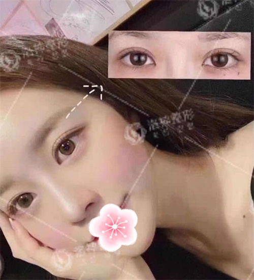 烟台洛神许川做双眼皮超赞，附：近期平扇形术后效果图！