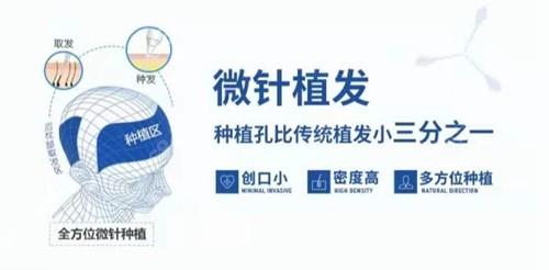 西安大麦微针植发技术优势