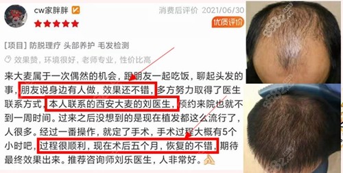 西安大麦微针植发前后对比照