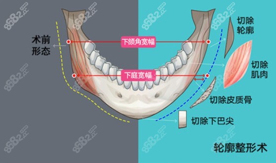 李运峰做下颌角截骨优势
