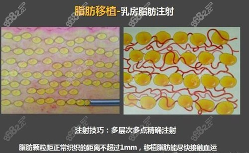 李发成多层次脂肪填充胸部