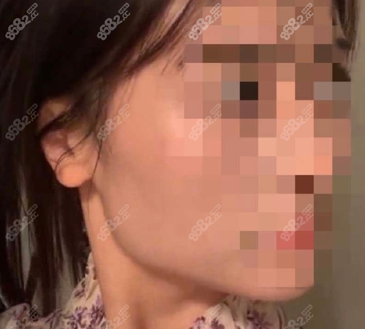 李运峰做下颌角术前