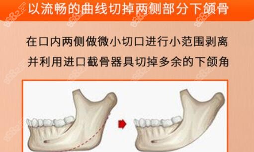 上海韦敏下颌角磨骨技术优势