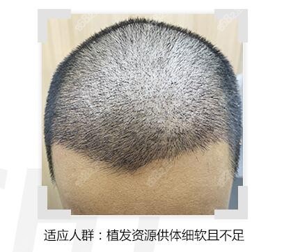 <!--<i data=20240705-sp></i>-->微针植发术后
