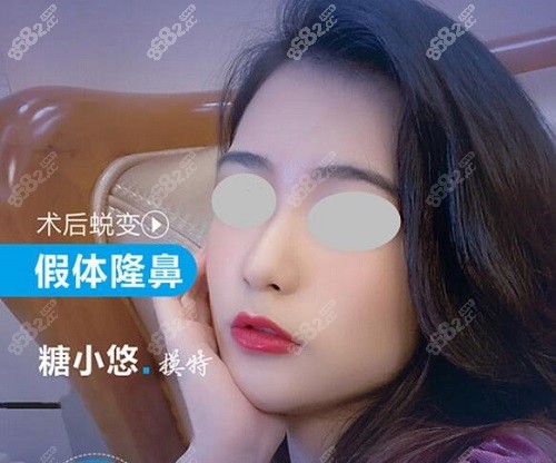深圳富华高静院长塑造的假体隆鼻术后真实反馈图