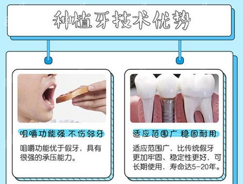 种植牙技术优势