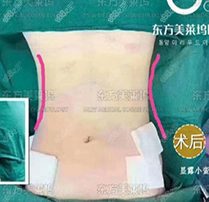 <!--<i data=20240705-sp></i>-->术后照片