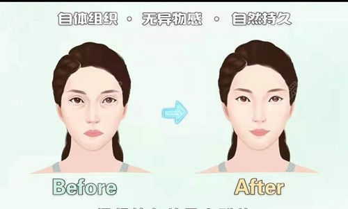 脂肪填充泪沟前后对比