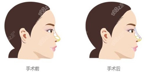 刘彦军做鼻子风格