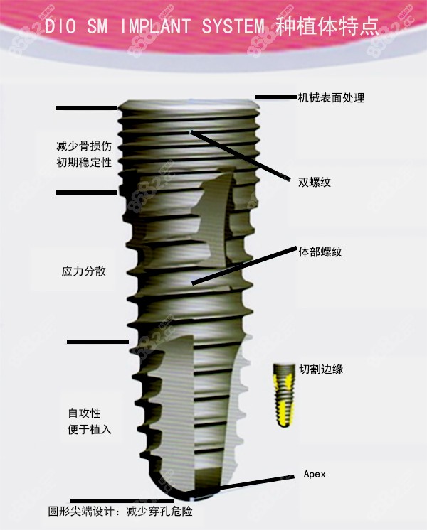 韩国DIO种植体的特点