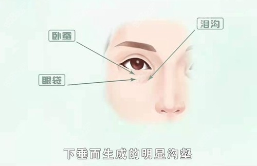 什么是泪沟？