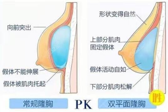 上海殷初阳医生做假体隆胸技术优势