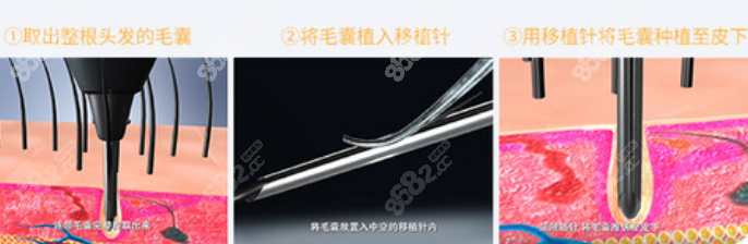 微针不剃发植发技术特点