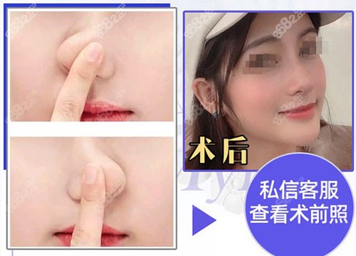 广州美莱刘豪鼻整形医生鼻整形真人术后图